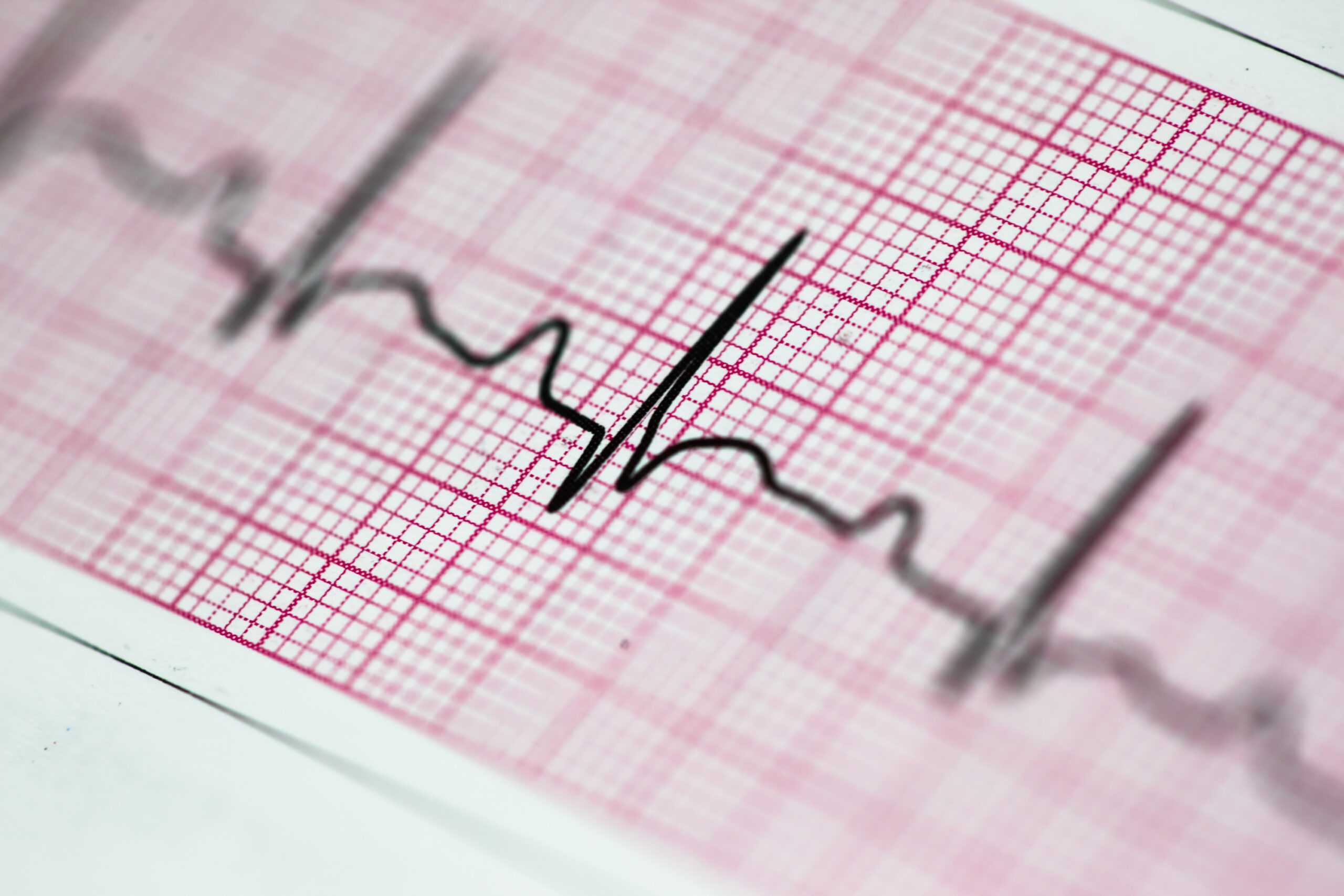 ECG heart trace